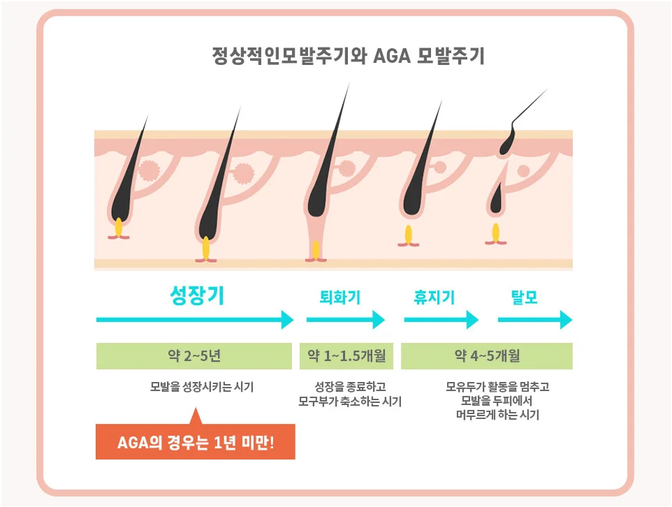 남성형 탈모치료제 핀페시아 정상적인 모발주시와 AGA모발주기